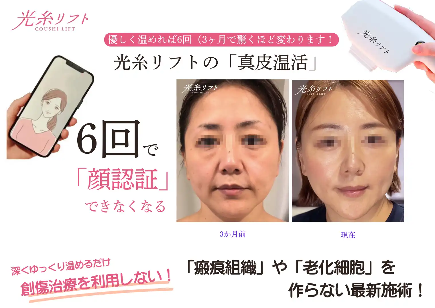 マリアローズ - 光糸リフト 打たず、切らず、削らずで「整形級」